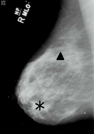 Mammogram with prompts