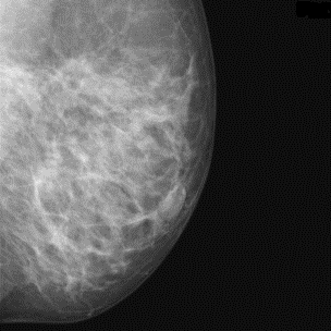 Digital mammogram