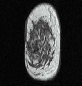 Breast MRI